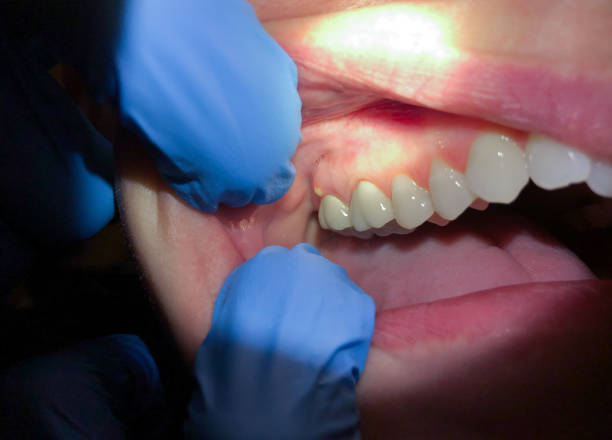 Best Emergency Dentist for Knocked-Out Tooth in Wills Point, TX